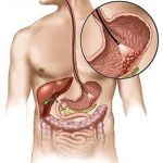 -stomach_cancer1