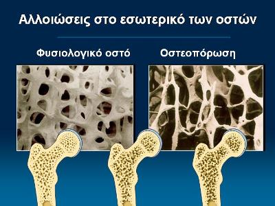 osteoporosh