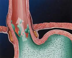 Gastroesophageal