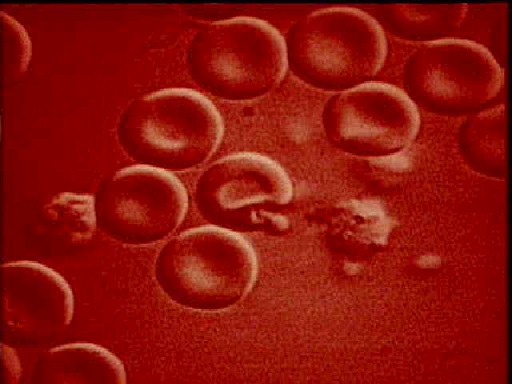 malaria