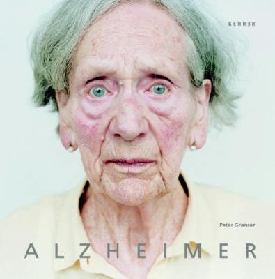 alzheimer